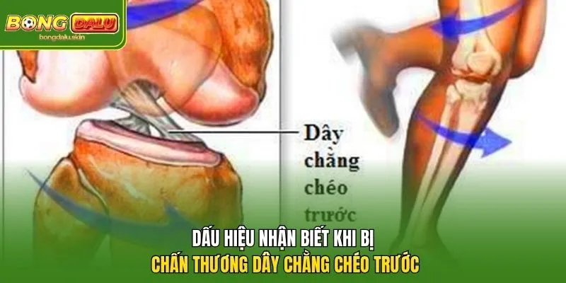 Dấu hiệu nhận biết khi bị chấn thương dây chằng chéo trước